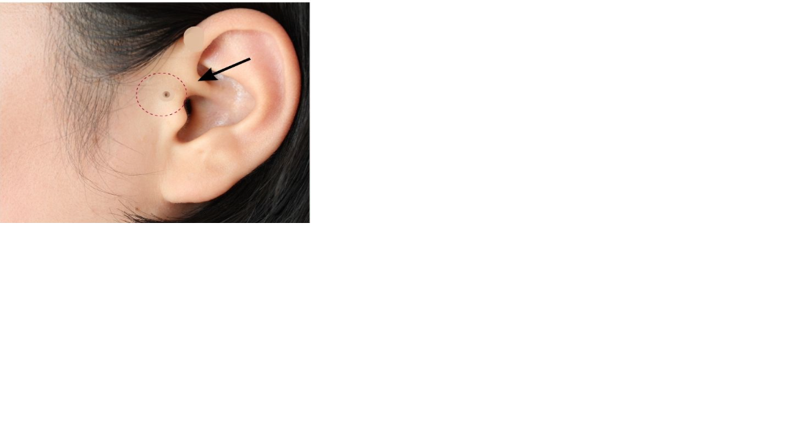 Preauricular notch